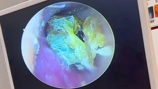 Super thick fungal dry slices in the ear canal [upl. by Sethi]