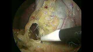 COLECISTECTOMIA POR VIDEOLAPAROSCOPIA  culture of safety in cholecystectomy [upl. by Garaway]