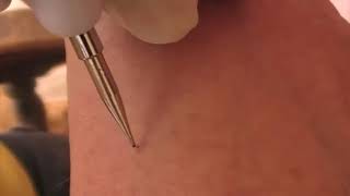 Freckle Removal Laser Pen [upl. by Roach]