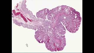 neoplasia robbins pathology full review with combined and enhanced quality [upl. by Scriven]