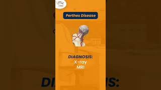 Perthes disease  Dr Pushpvardhan Mandlecha  Paediatric [upl. by Glynas211]