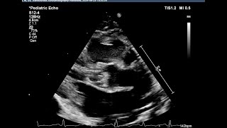 Basic echocardiography심장 초음파 기본 Bicuspid aortic valve dysplastic aortic valve [upl. by Treblihp255]