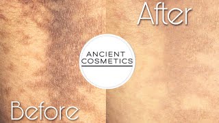 CLEARER SKIN AFTER 1 USE‼️ Ancient Cosmetics Update✨ CONFLUENT amp RETICULATED PAPILLOMATOSIS CURE😩 [upl. by Inihor]