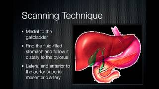 pyloric stenosis [upl. by Haroppizt]