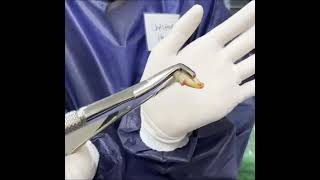 how to teach lower third molar extraction with forcep [upl. by Whitehurst758]