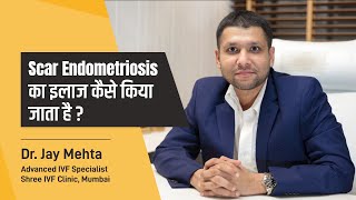 Scar Endometriosis का इलाज कैसे किया जाता है   Treatment of Scar Endometriosis  Dr Jay Mehta [upl. by Benny826]