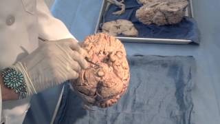 Orientation The Planes of the Brain Neuroanatomy Video Lab  Brain Dissections [upl. by Torras]