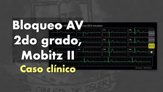 Caso clínico Bloqueo AV de 2do grado Mobitz II [upl. by Kiran]