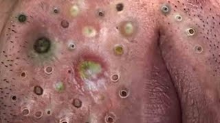 Acne treatment Blackhead remove with Spa Loan [upl. by Nomolas]