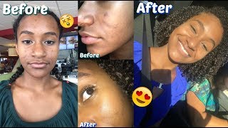 GET RID OF ACNE SCARS WITH ONE PRODUCT [upl. by Nalniuq]