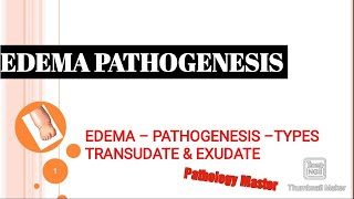 EDEMA  Pathogenesis Of Development [upl. by Petromilli]