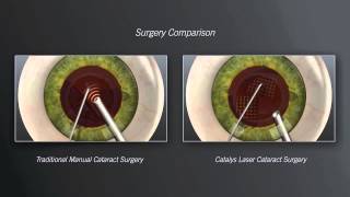 Catalys Laser Cataract Surgery vs Traditional Manual Cataract Surgery  Animation [upl. by Minda]