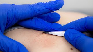 How to get rid of Skin Tags  Advanced electrolysis [upl. by Ehcram]