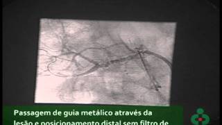 Angioplastia de Artéria Renal [upl. by Lahcar613]