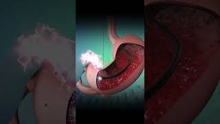 GI Endoscopy Animation  Step by Step Visual Guide for Patients [upl. by Teilo]