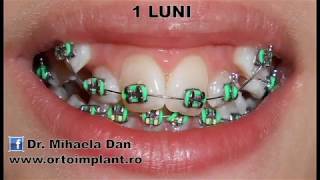 Aparat Dentar Fix  Ortodontie copii [upl. by Demahom]