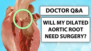 Doctor QampA The Progression and Surgery of Dilated Aortic Root Aneurysms with Dr Luis Castro [upl. by Zashin]