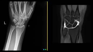 What is an MRI wrist arthrogram [upl. by Refinney]