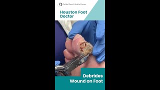 Wound Debridement by Houston Foot Doctor woundcare podiatrist footdoctor [upl. by Negriv416]