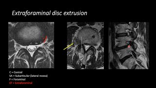 Lumbar Spine MRI by Eric Tranvinh MD Stanford Radiology [upl. by Archy274]