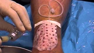 TREATMENT OF SKIN ULCERS  Application of collagen membrane GENIX IT [upl. by Frazier]