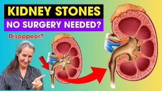 Can KIDNEY STONES Really Disappear On Their Own [upl. by Creath]