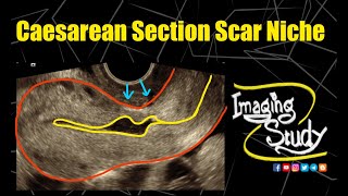 Caesarean Section Scar Niche  Ultrasound  TVS  Case 297 [upl. by Onairotciv]