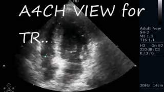 ACUTE MR  CHORDAE RUPTURE ECHOCARDIOGRAPHY SERIE [upl. by Nanyt]