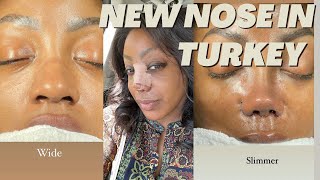 I Got a ETHNIC RHINOPLASTY in TURKEY 🇹🇷 [upl. by Nac464]