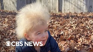 Boy has uncombable hair syndrome [upl. by Shena222]