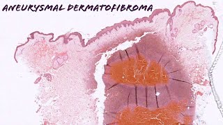 Aneurysmal dermatofibroma dermatofibroma with internal hemorrhage pathology dermpath dermatology [upl. by Phil]