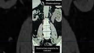 Obstructive uropathy ureteric calculus kidneystone ctscan renalfailure s9teleradiology [upl. by Lednyc]