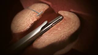 UroLift System Animation [upl. by Ahseal]