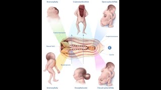 Types of congenital anomalies Abnormalities  Disruption Malformation Deformation and dysplasia [upl. by Kcitrap541]