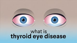 What is Thyroid Eye Disease TED [upl. by Burrow355]