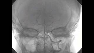 Selective Intraarterial Thrombolysis for Cardioembolic Stroke [upl. by Nylhtak]