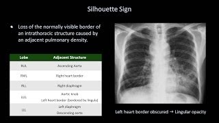 How to Interpret a Chest XRay Lesson 8  Focal Lung Processes [upl. by Quarta327]