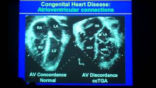 Complex Congenital Segmental Approach 44 Min Lecture [upl. by Frieder822]