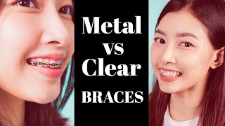 Clear Braces vs Metal Braces Which One Is Right for You [upl. by Fisa15]