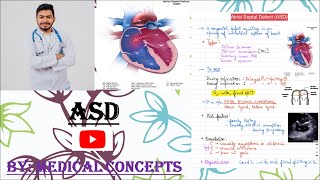 Sinus Venosus Atrial Septal Defect [upl. by Ora381]