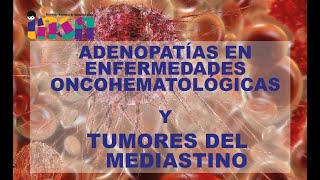 Adenopatías en Enfermedades Oncohematológicas Y Tumores del Mediastino  Telecapacitación INSN [upl. by Einahpet]