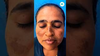 📍📍முகத்தில் மங்கு இருக்கா melasma skincaretips melasmatreatment rootcause functionalmedicine [upl. by Hilarius]