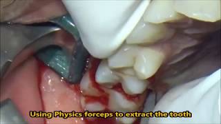 Extraction of decayed maxillary premolar amp molar using Physics forceps [upl. by Benisch28]