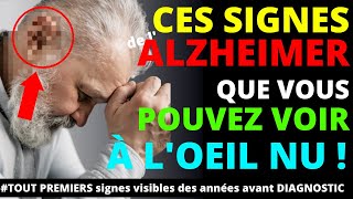 4 signes visibles à loeil nu et précoce de la maladie de lAlzheimer [upl. by Hose]