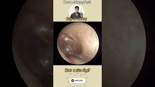 고막염증제거 otitismedia needle aspiration satisfyingvideo ENT [upl. by Nayra]