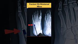 FRACTURE 5th Metatarsal Bone Xray Foot radiographerusn radiography xray bones [upl. by Carbrey]