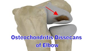 osteochondritis dissecans of the elbow [upl. by Fry]