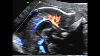 ISUOG How to image the fetal corpus callosum course of the pericallosal artery [upl. by Novyart41]