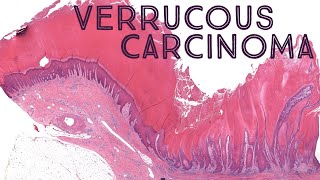 Verrucous carcinoma AIP France 2021  Case 6 [upl. by Ylime]