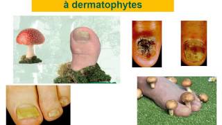 DERMATOLOGIE MYCOSES SUPERFICIELLES [upl. by Ecnarwal899]